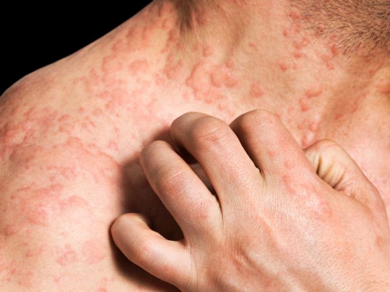 Adult Onset Eczema Later in Life - National Eczema Association